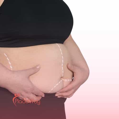 Bariatric Surgery in Turkey: Life-Changing Weight Loss Surgery for Qatar Patients with Type 2 Diabetes